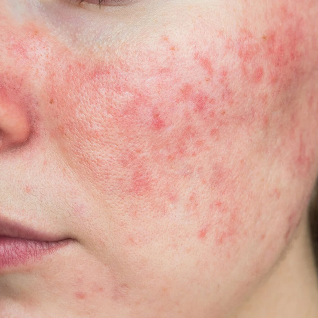 sådan ser rosacea ud